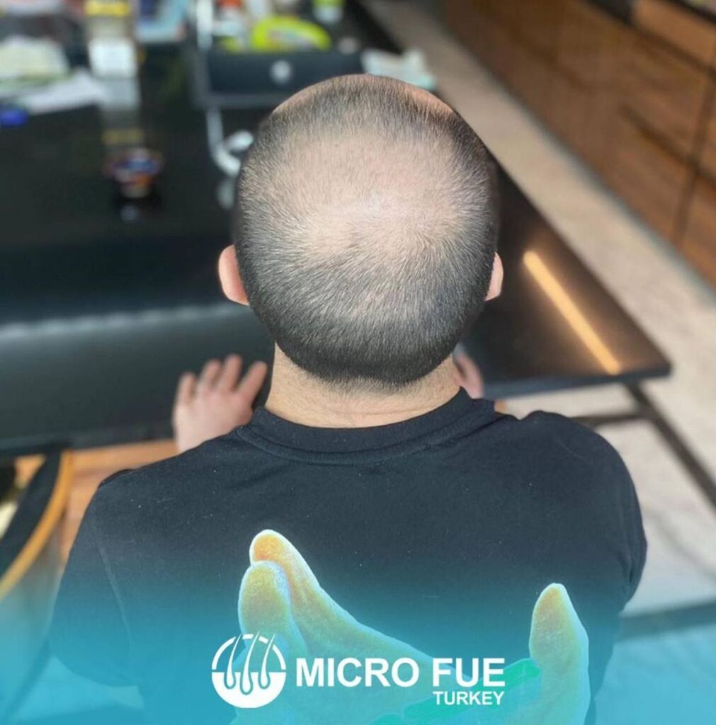 bodrum hair transplant