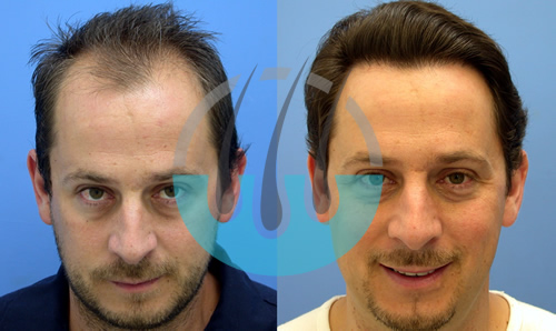 Marmaris Hair Transplant Before After