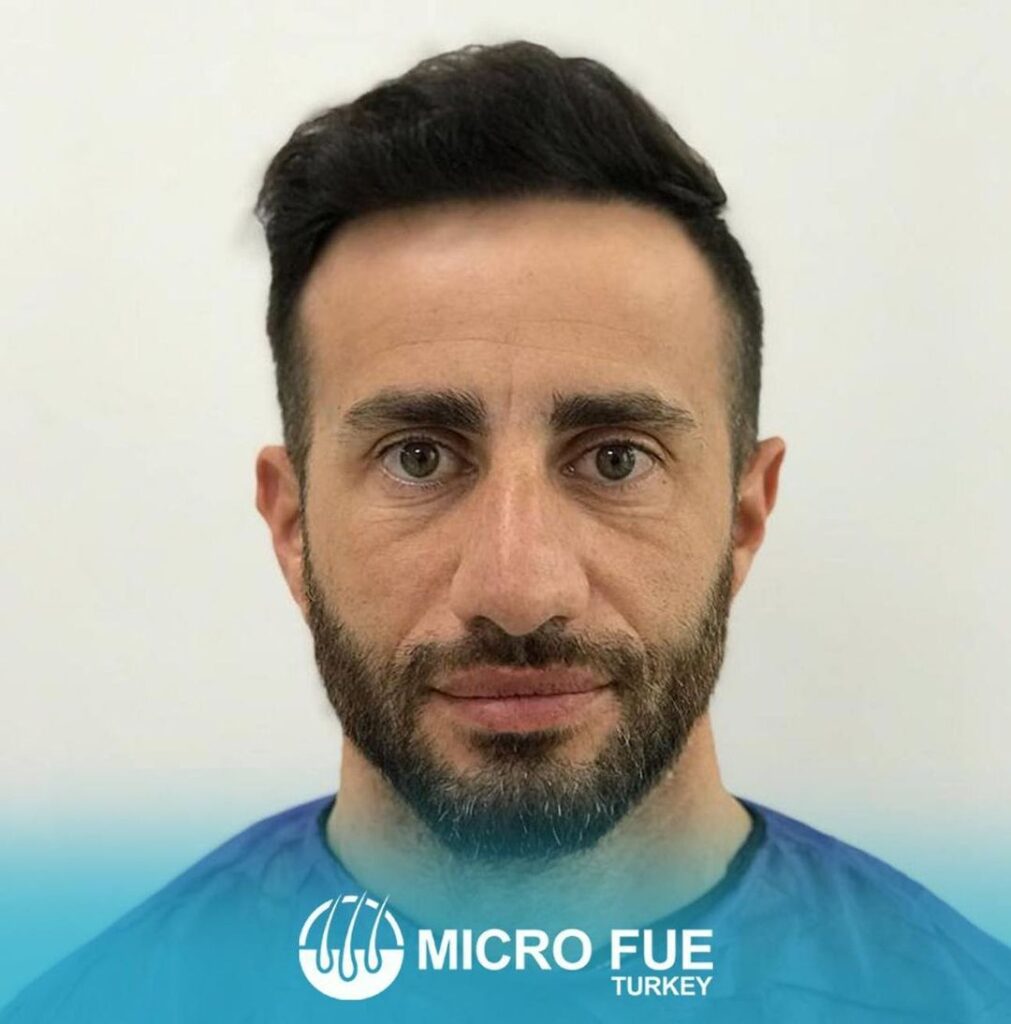 hair transplant bodrum