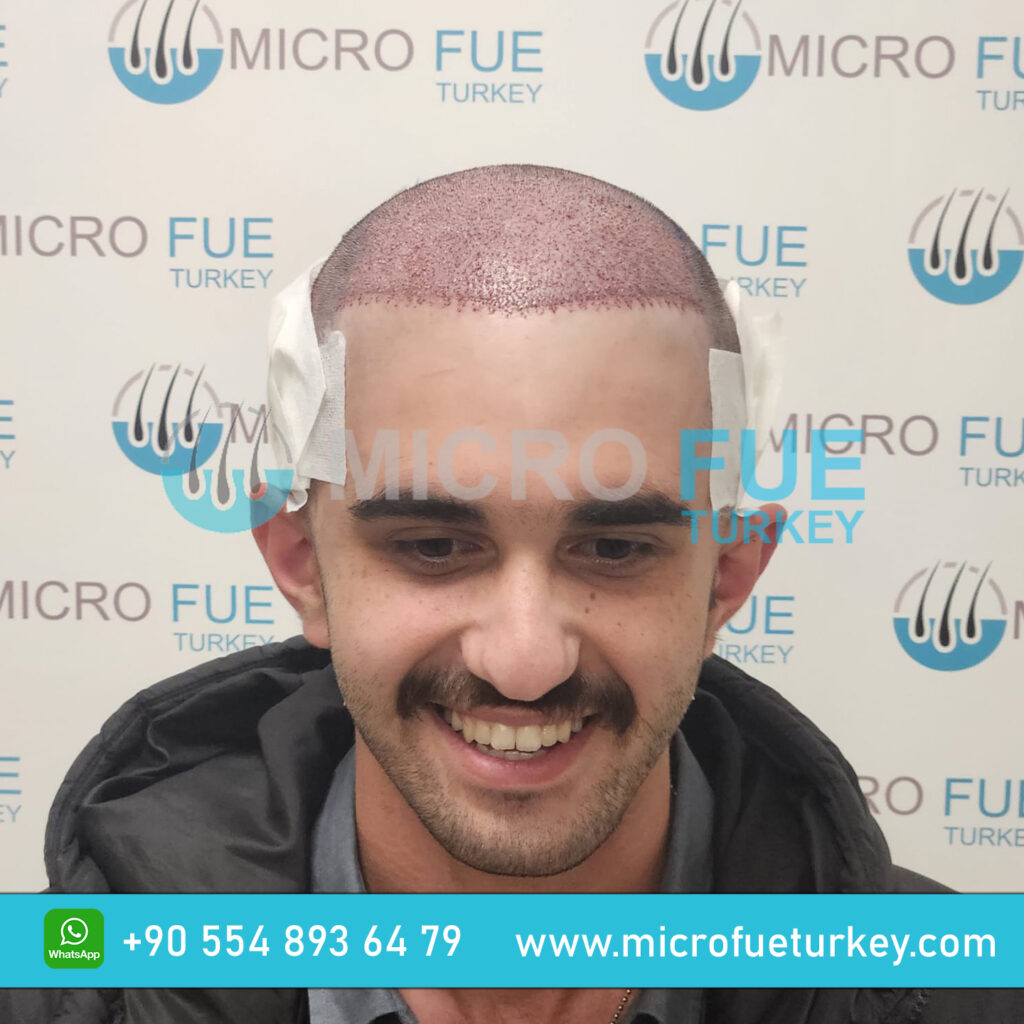 Hair Transplant in Turkey