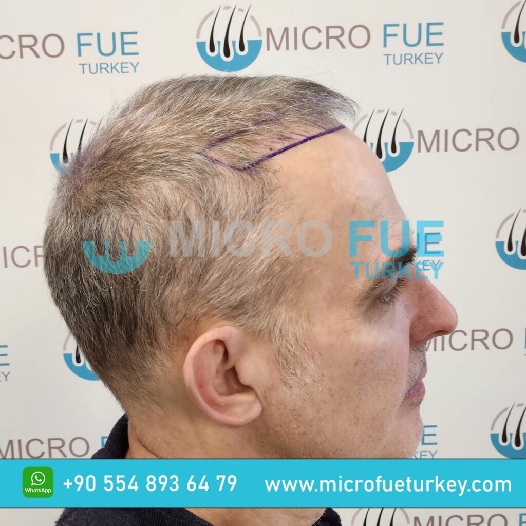 Hair Transplant Kusadasi