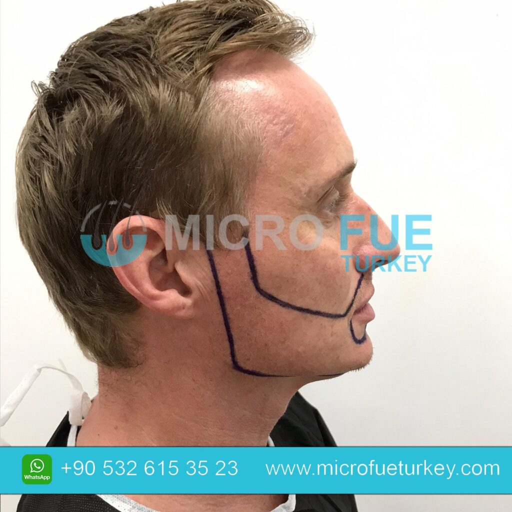 Beard Transplant in Istanbul