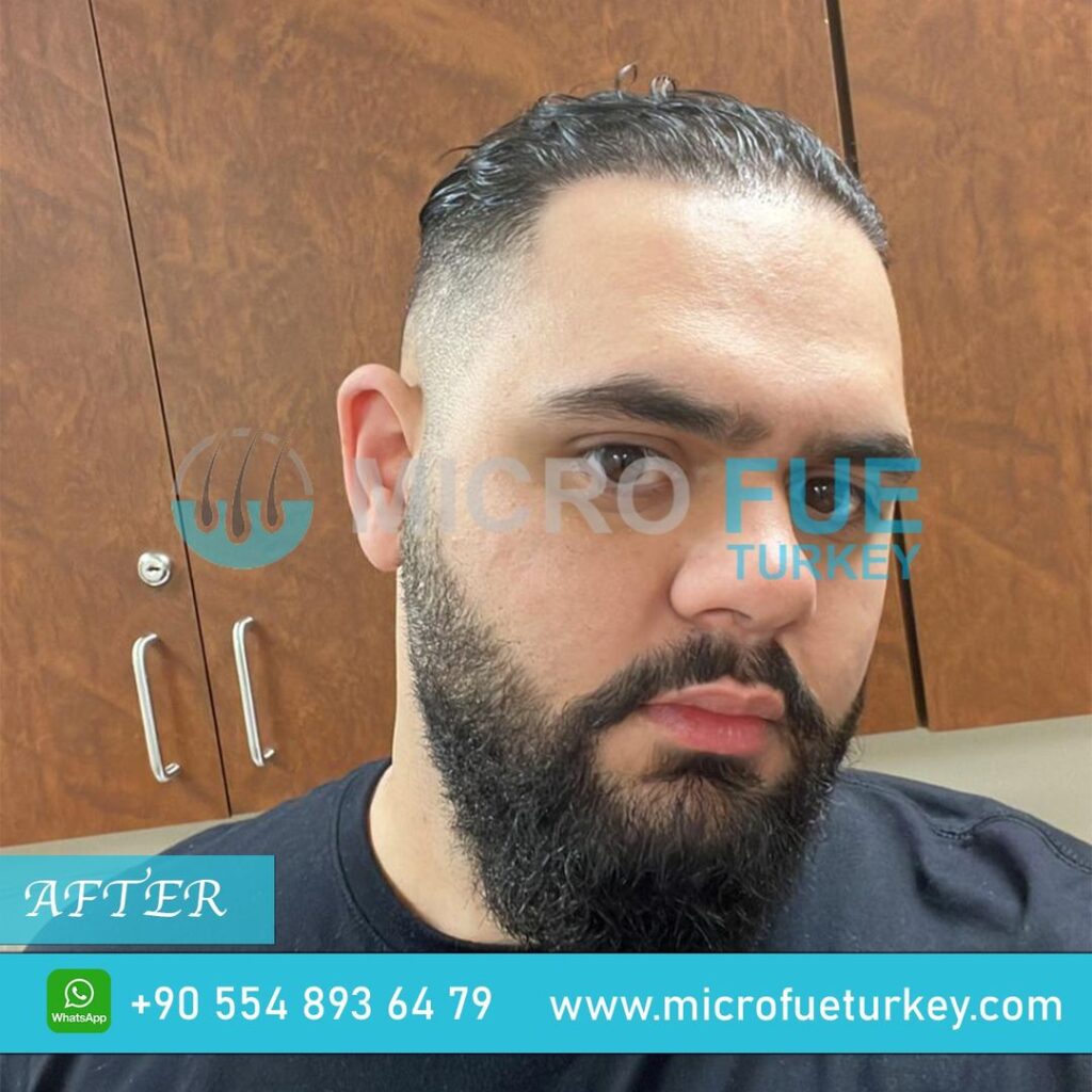 Hair Transplant in Dalaman