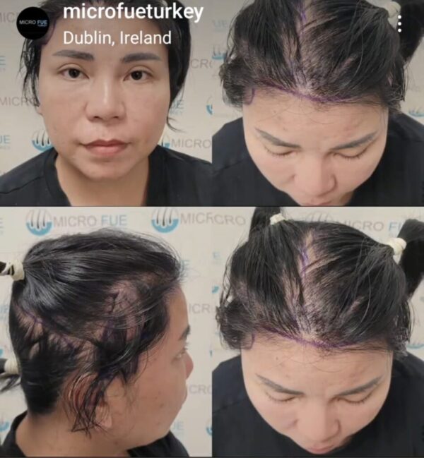 Woman Hair Transplant in Istanbul, Turkey