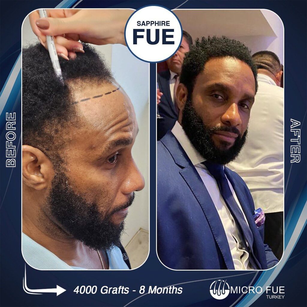 Hair Transplant in Kadikoy