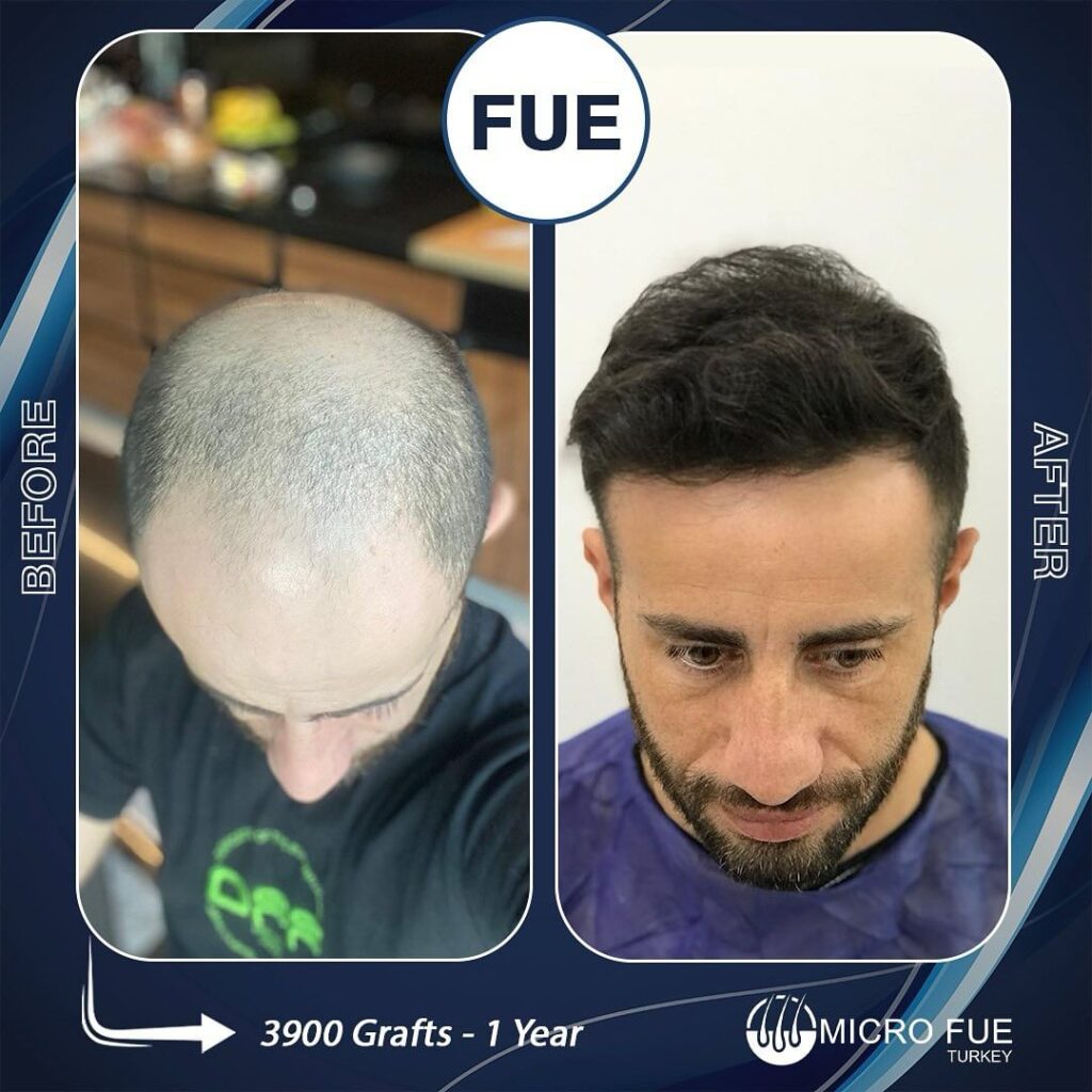 Micro Fue Turkey