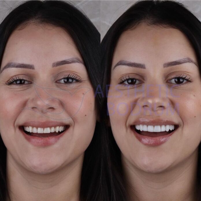 Dental Treatments in Milas Dental Treatments in Milas