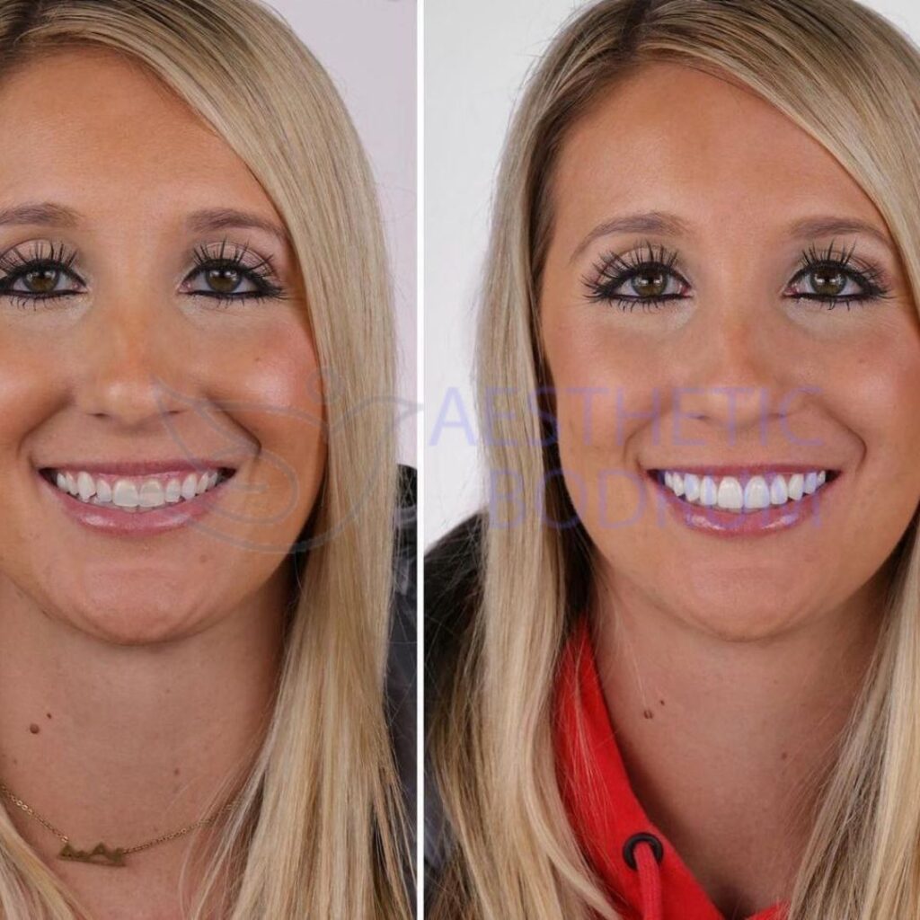 Dental Treatments In Rhodes BeforeAfter