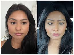 Aesthetic Surgeries in Bodrum Before After