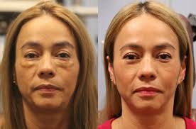 Aesthetic Surgeries in Bodrum Before After