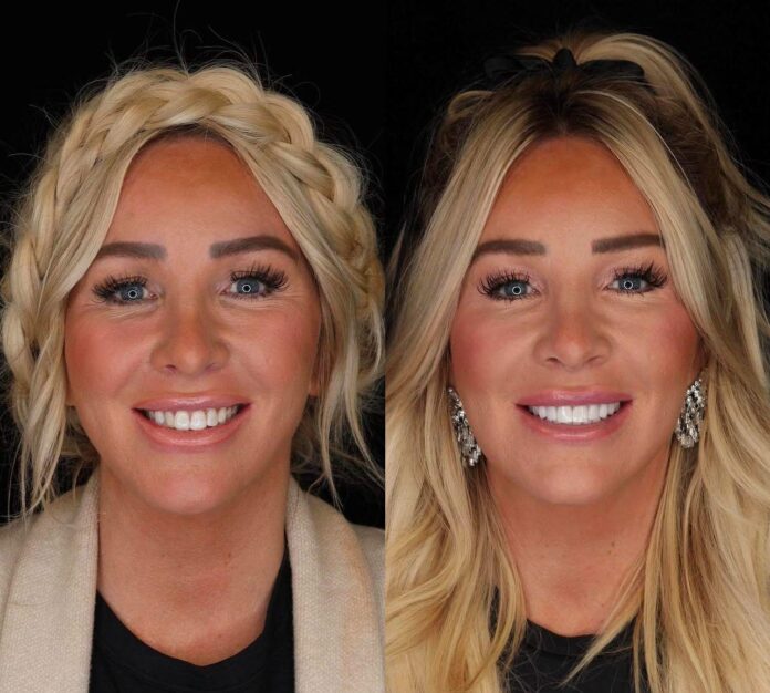 Emax Veneer in Kos