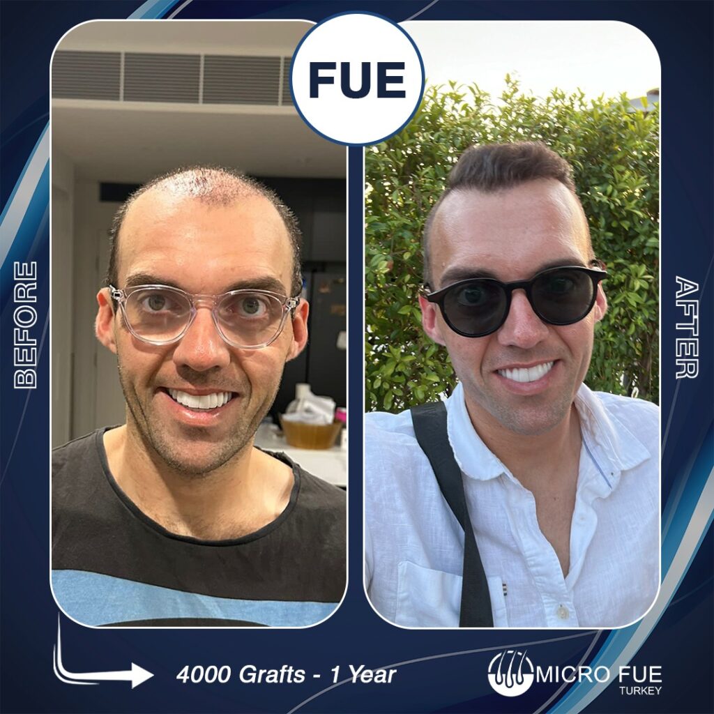 How to Make a Reservation for a Hair Transplant in Antalya