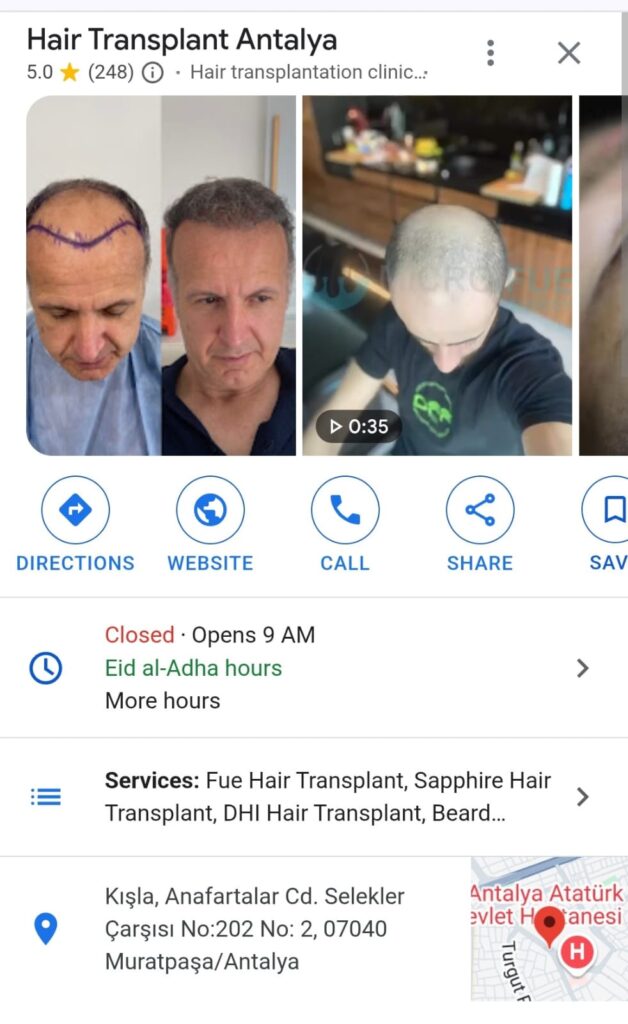 Why Antalya is Becoming a Global Hub for Hair Transplant Tourism