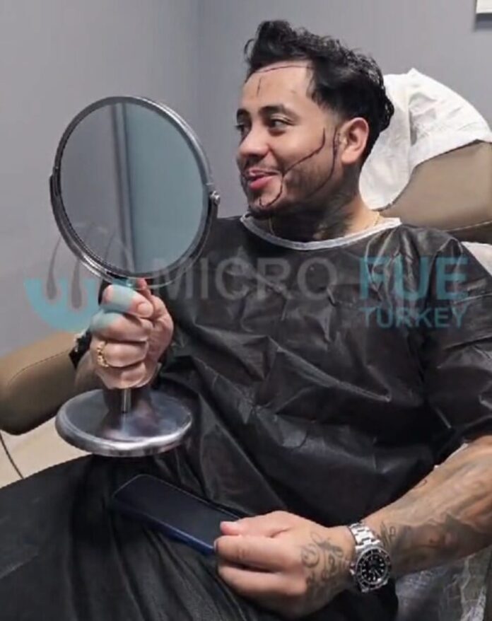 Why Turkey is the Global Leader in Hair Transplants