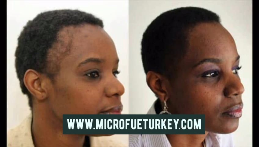 Female Hair Transplant