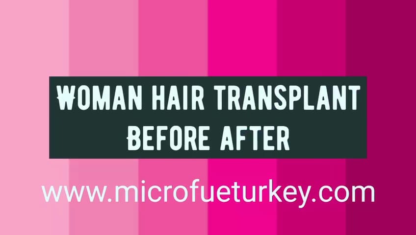 Female Hair Transplant