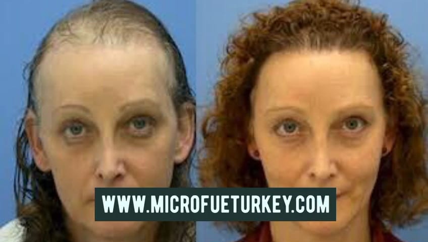 Female Hair Transplant