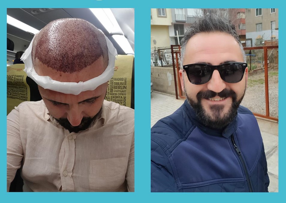 Hair Transplant Fethiye - Bodrum Holiday