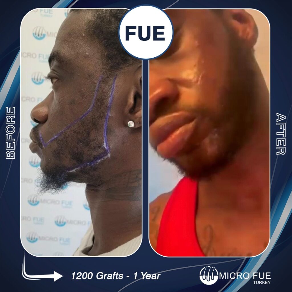 Beard Transplant in Istanbul, Turkey Before After