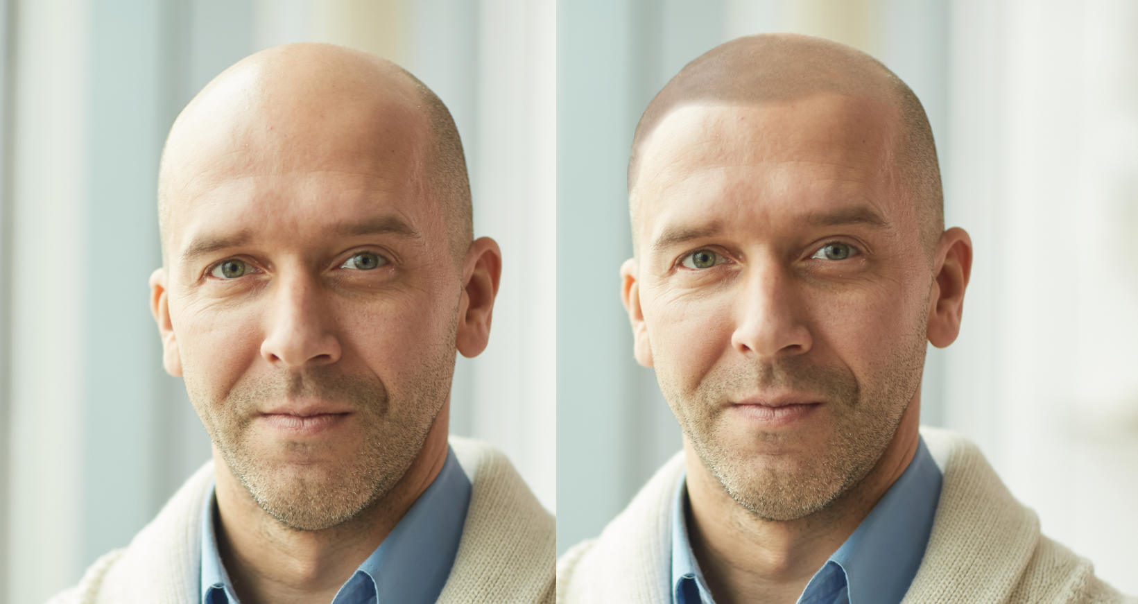 Scalp Micropigmentation in Bodrum - A Rising Trend in Hair Restoration
